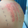 皮肤刺痛测试一个人的背上:皮肤刺痛测试一个人的背上