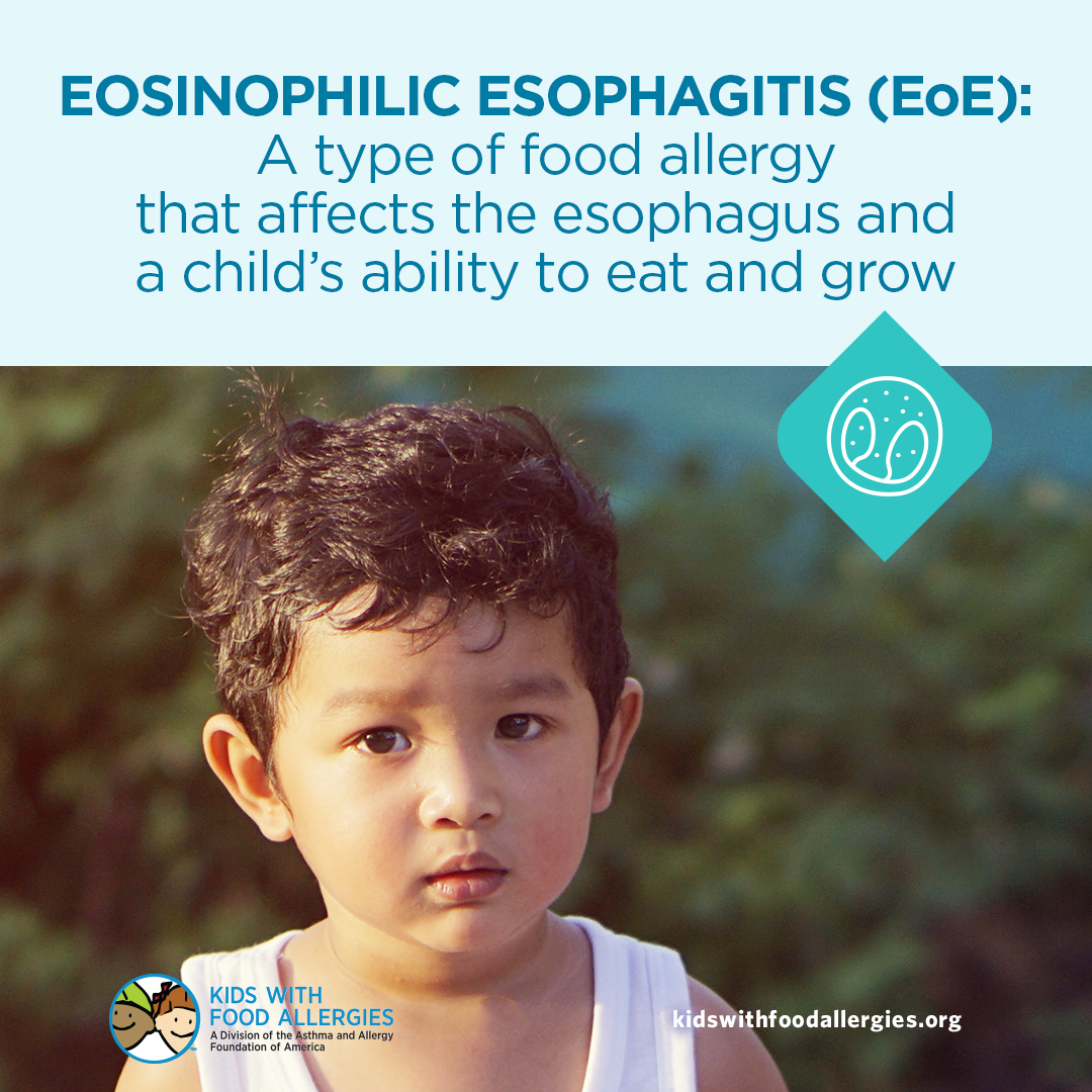 嗜酸性食管炎(EoE)是一种食物过敏，影响儿童的进食和生长能力